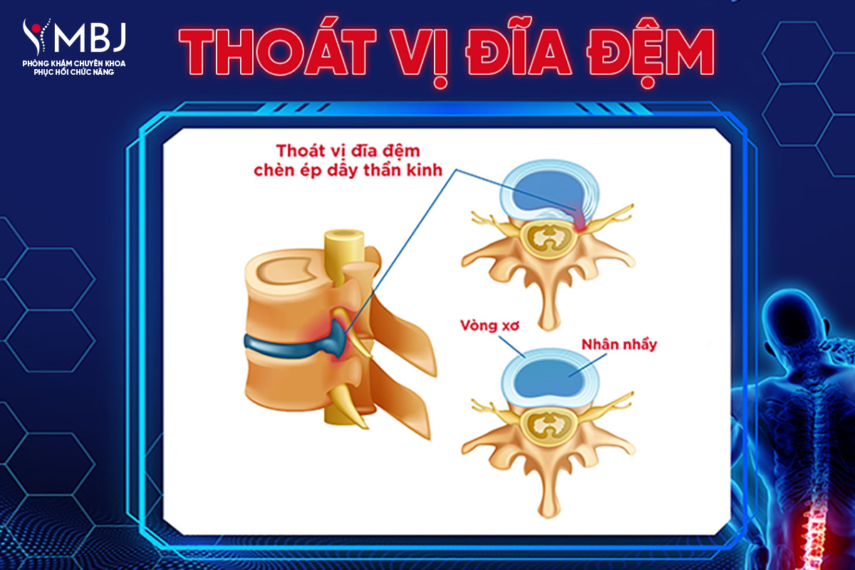 Thoát vị đĩa đệm