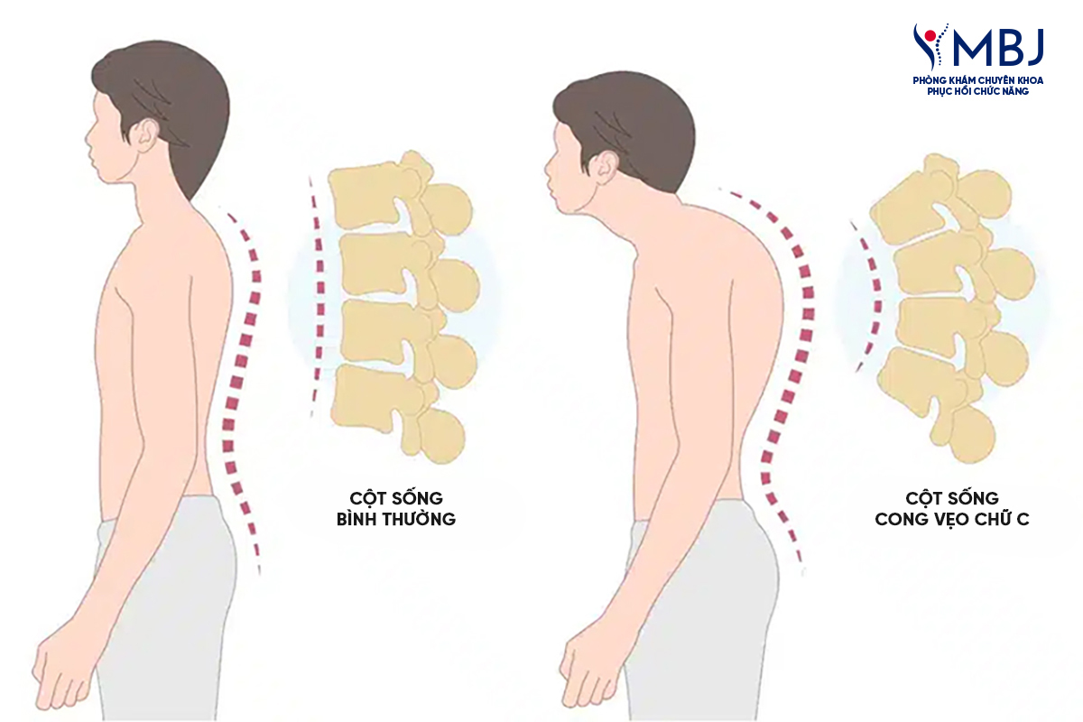 Cong vẹo cột sống chữ C