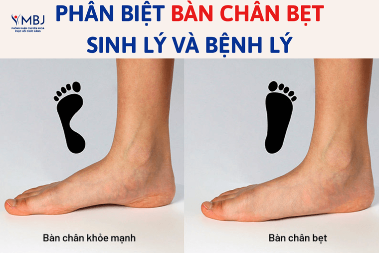 Bàn chân bẹt ở trẻ em