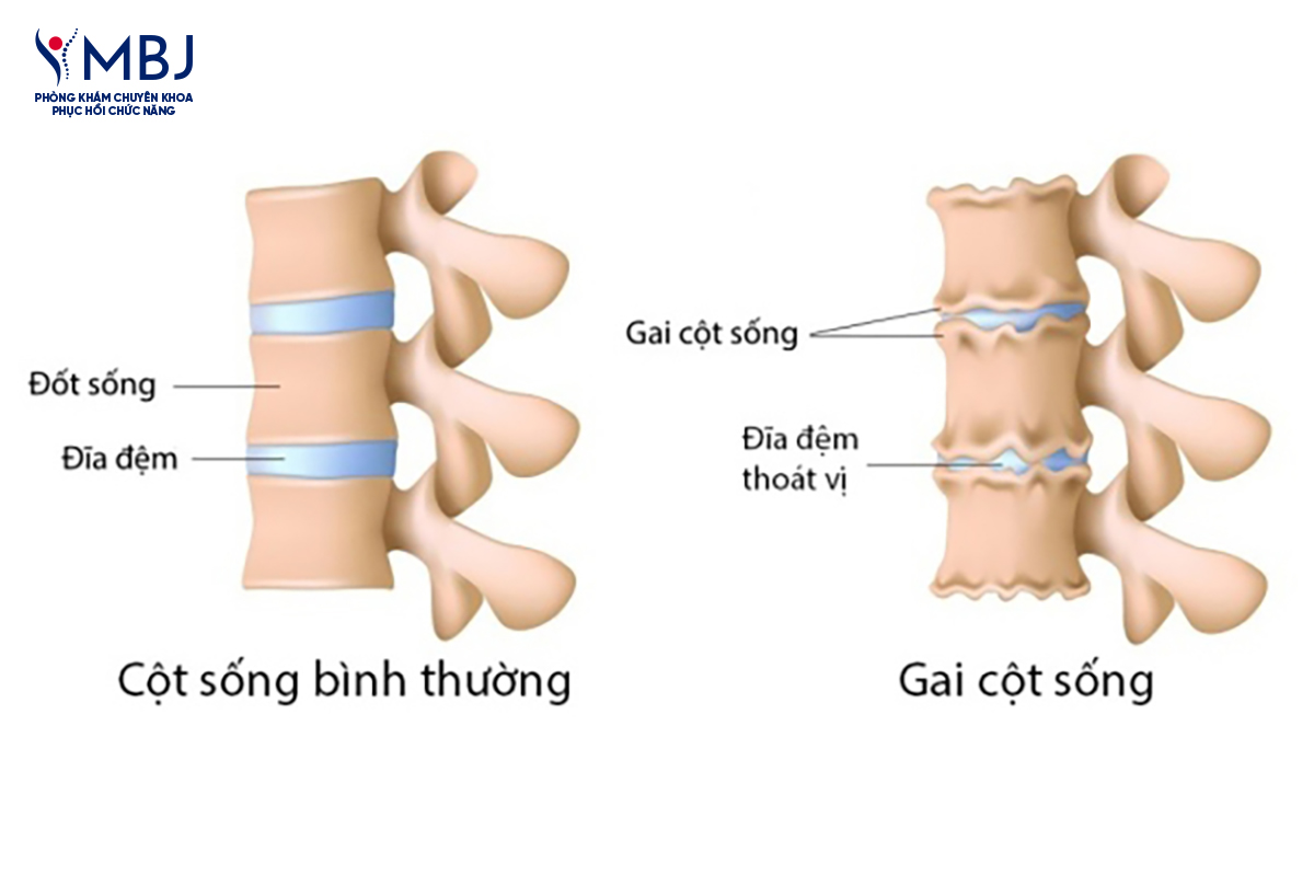 Dấu hiệu nhận biết Gai cột sống
