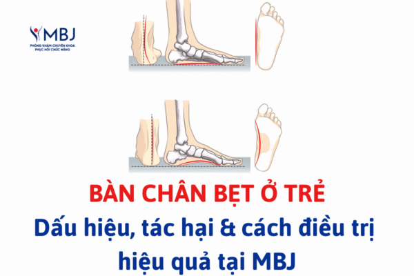 điều trị bàn chân bẹt ở trẻ