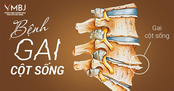 điều trị gai cột sống