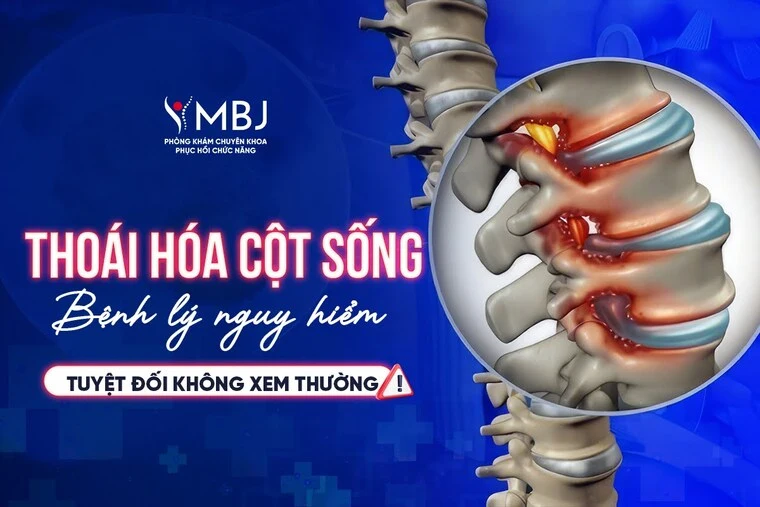 Điều trị thoái hóa cột sống