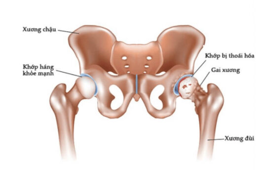 Điều trị thoái hóa khớp háng