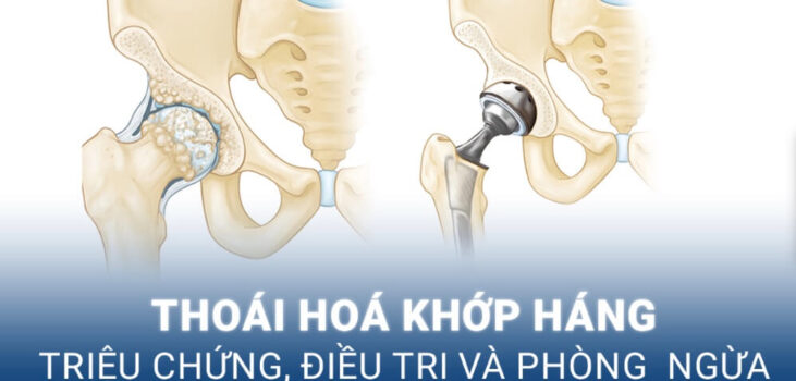 Điều trị thoái hóa khớp háng