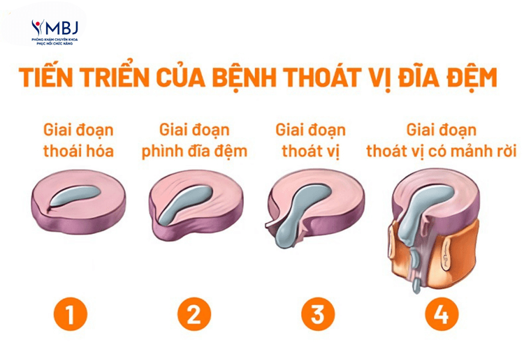 điều trị thoát vị đĩa đệm
