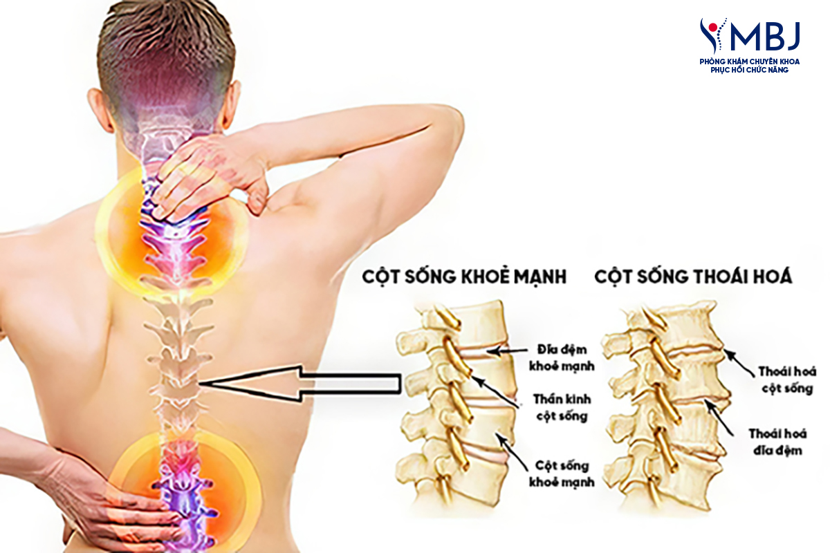 Thoái hóa cột sống