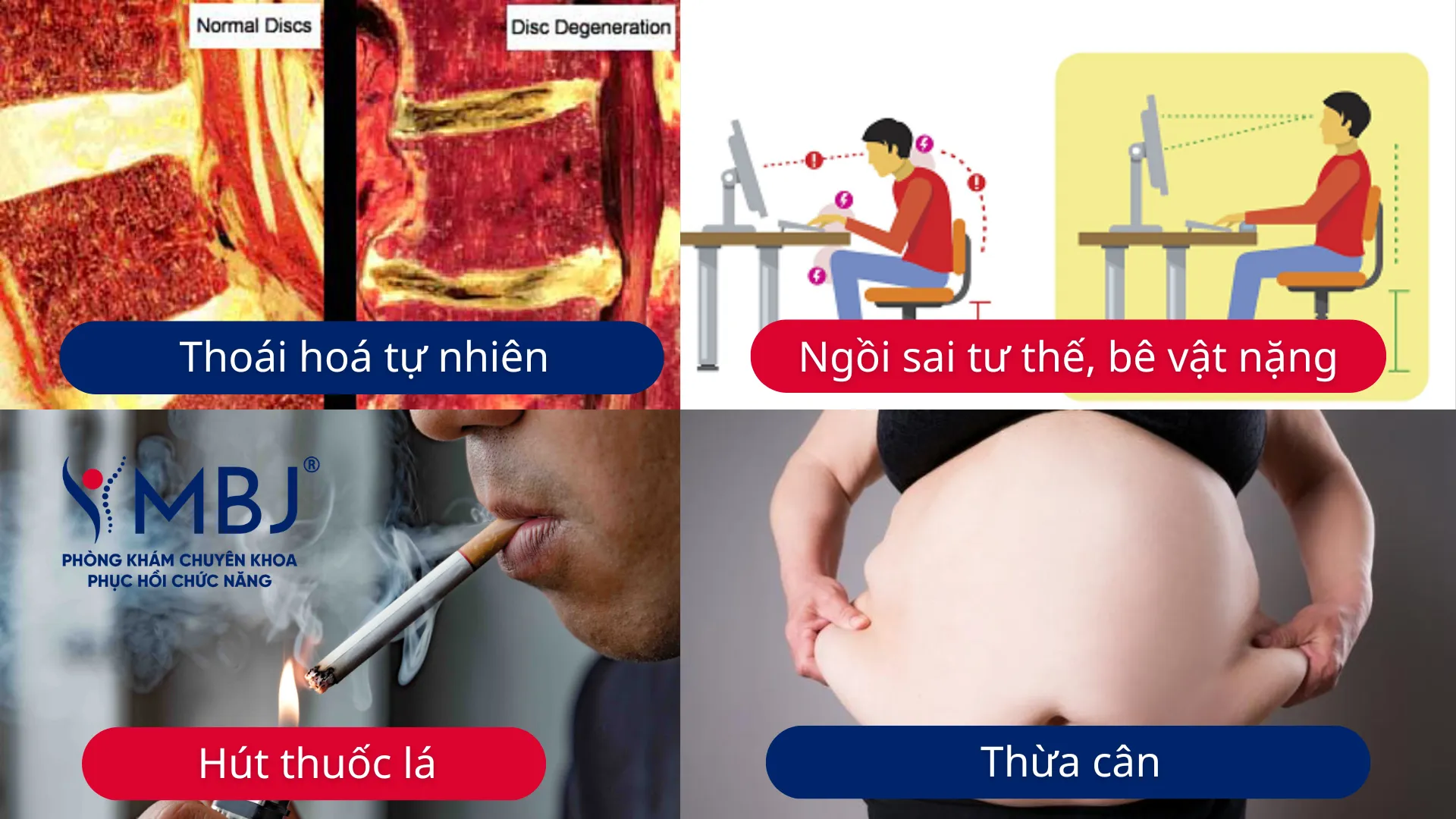Nguyên nhân gây ra thoát vị đĩa đệm