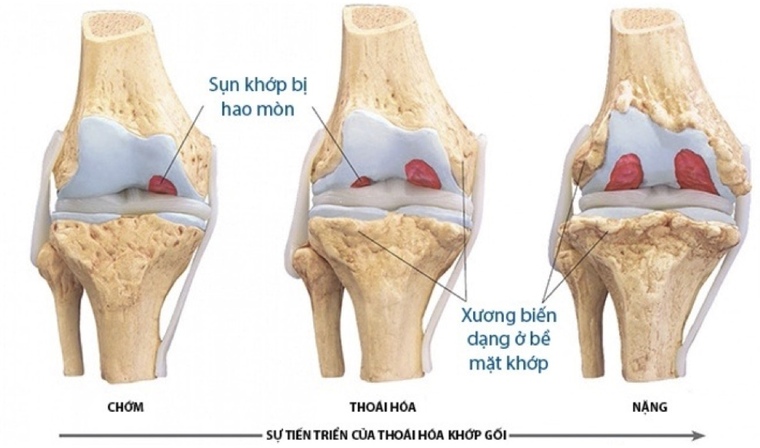 Điều trị thoái hóa khớp gối: triệu chứng