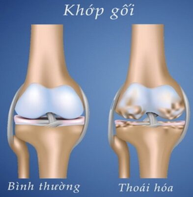 điều trị thoái hóa khớp gối