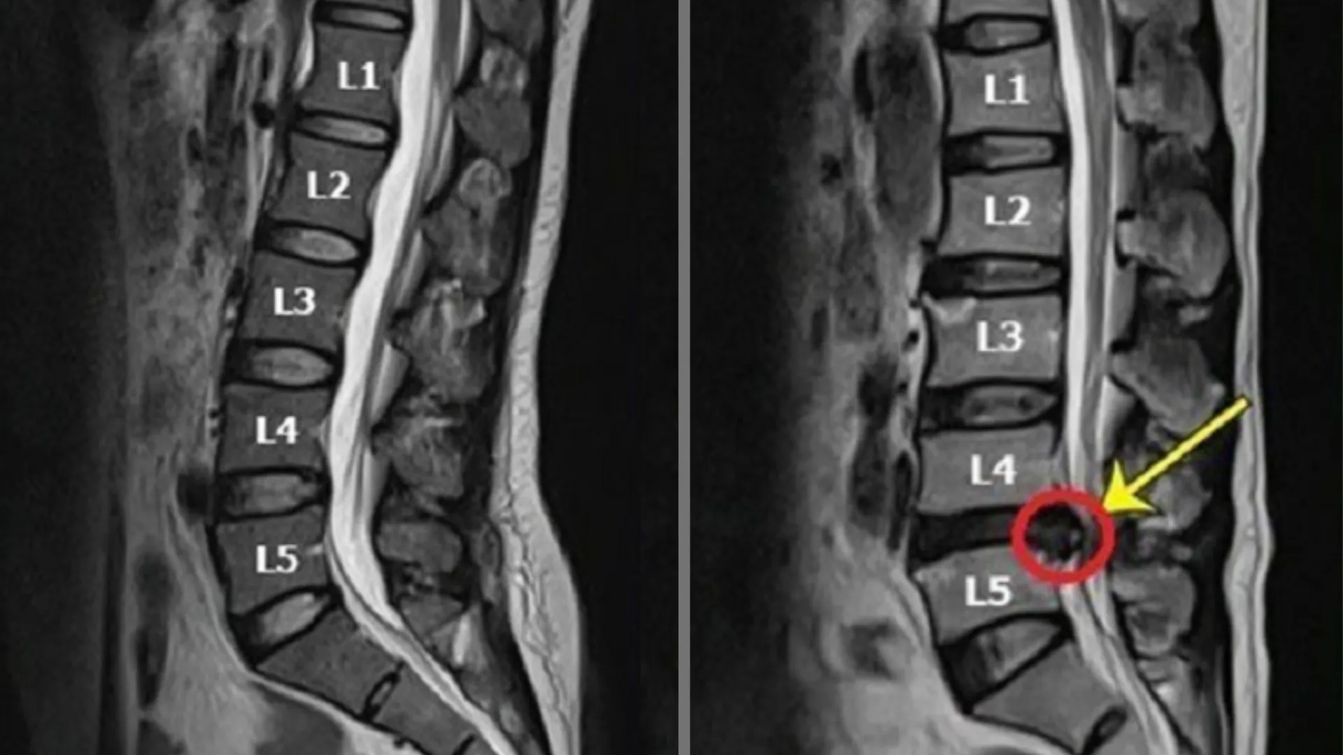 Bệnh thoát vị đĩa đệm được chụp bằng MRI