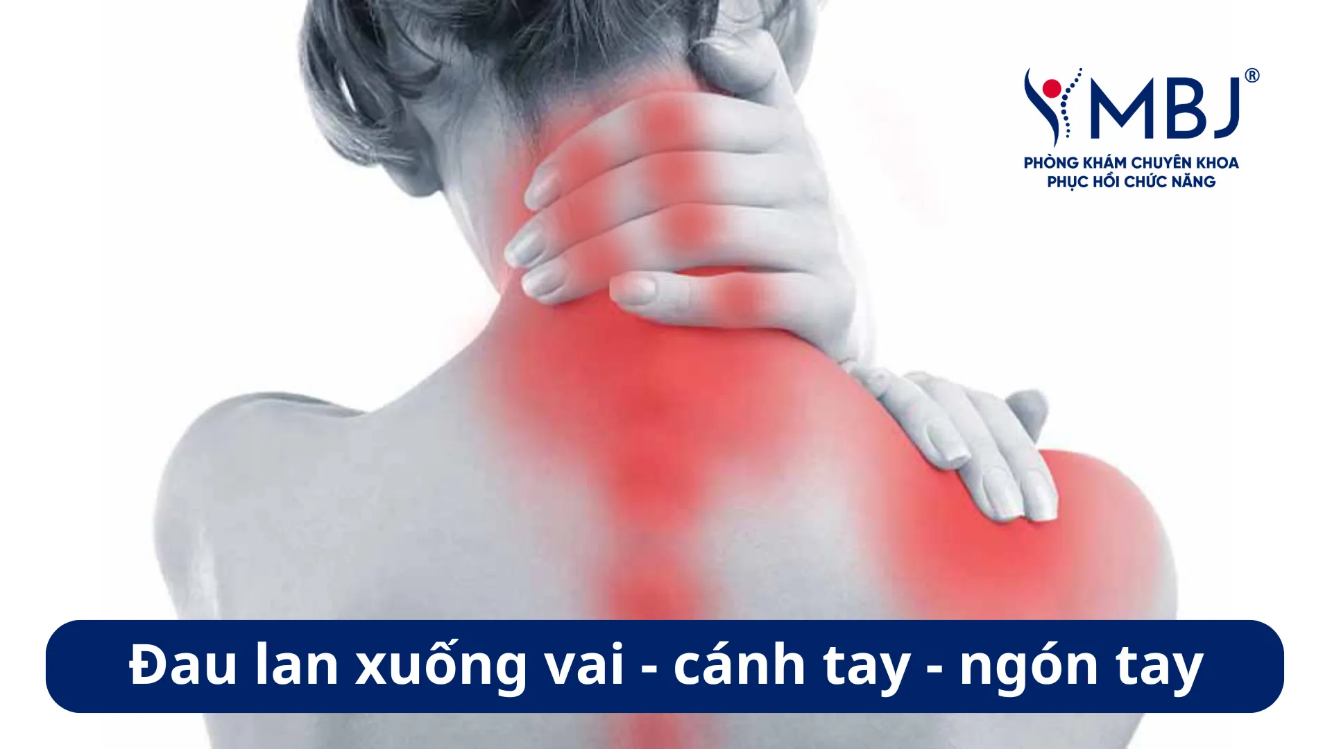 Thoát vị đĩa đệm gây đau lan xuống vai - cánh tay - ngón tay