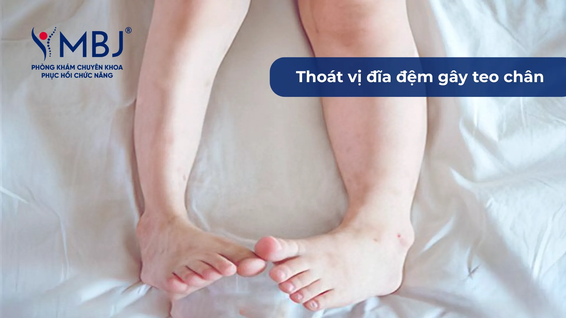 Thoát vị đĩa đệm có thể gây teo chân nếu để bệnh kéo dài