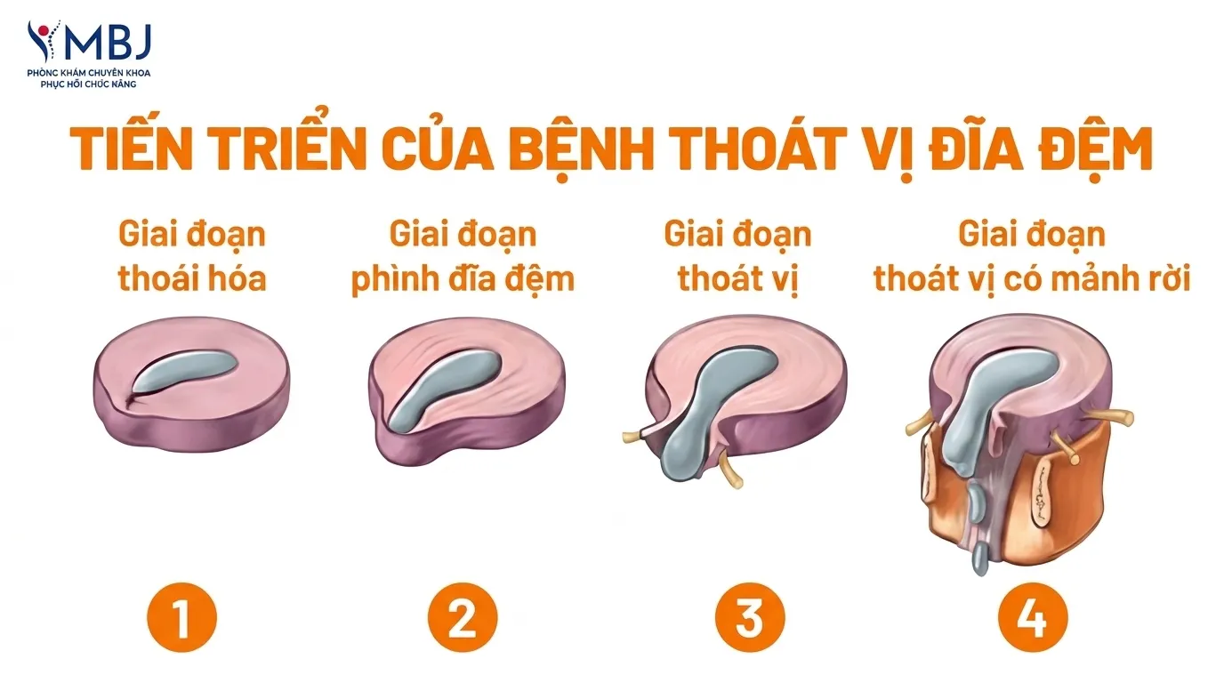 Tiến triển của thoát vị đĩa đệm