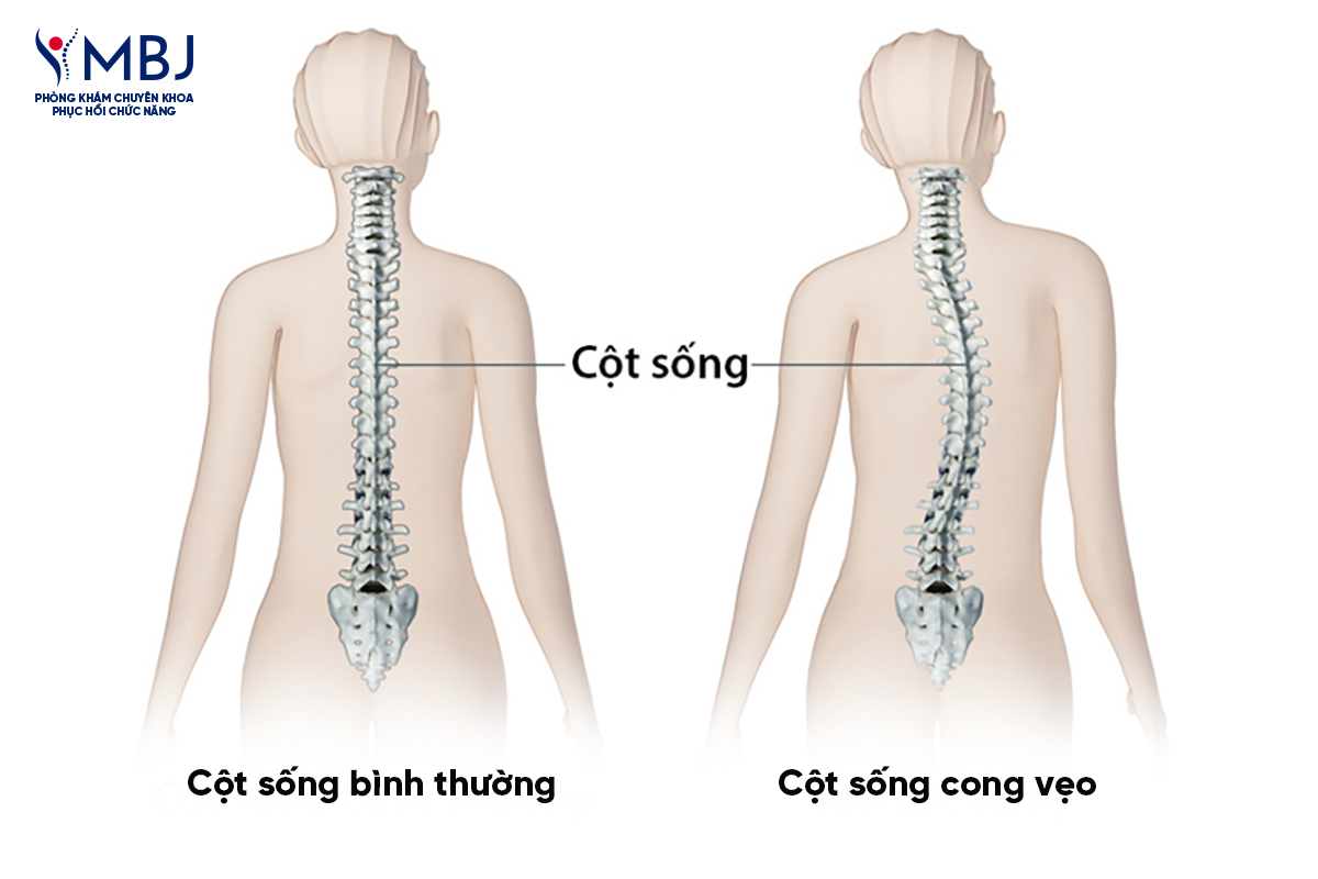 Cong vẹo cột sống