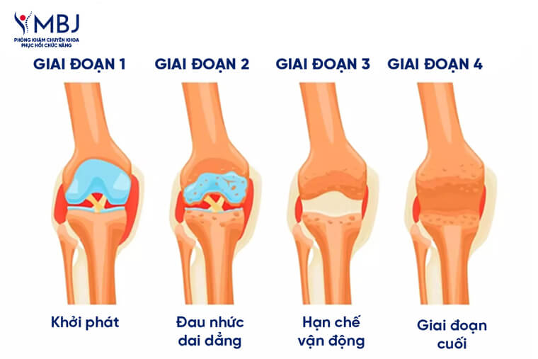 Các giai đoạn viêm khớp dạnh thấp