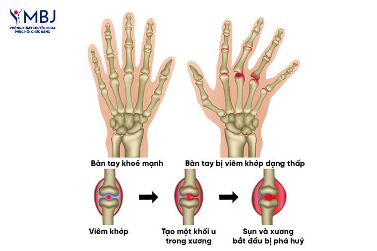 điều trị viêm khớp dạng thấp