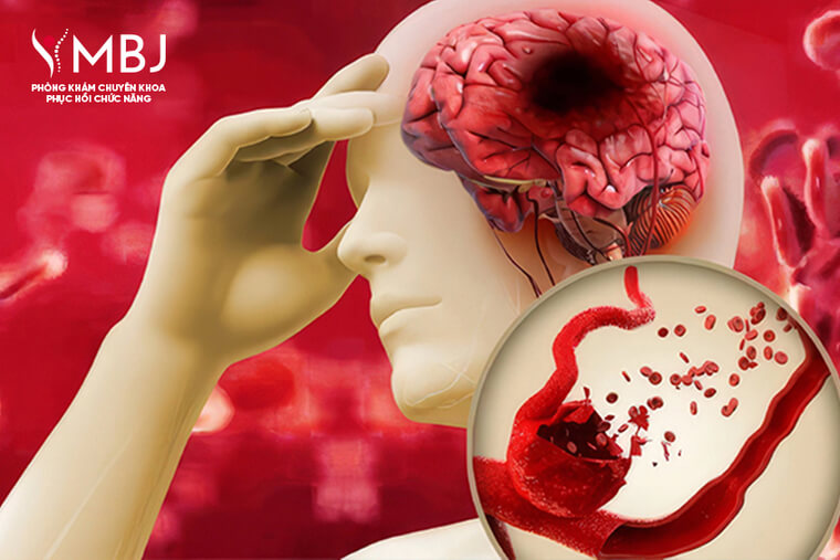 điều trị thoát vị đĩa đệm cột sống cổ