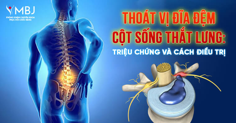thoát vị đĩa đệm cột sống thắt lưng
