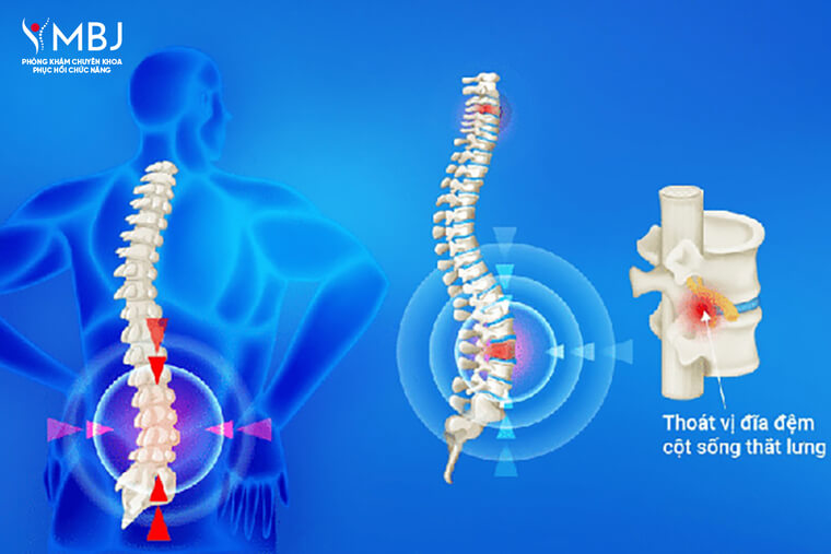 Thoát Vị Đĩa Đệm Cột Sống Thắt Lưng là gì