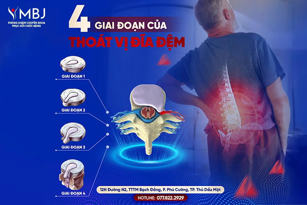 4 giai đoạn của thoát vị đĩa đệm