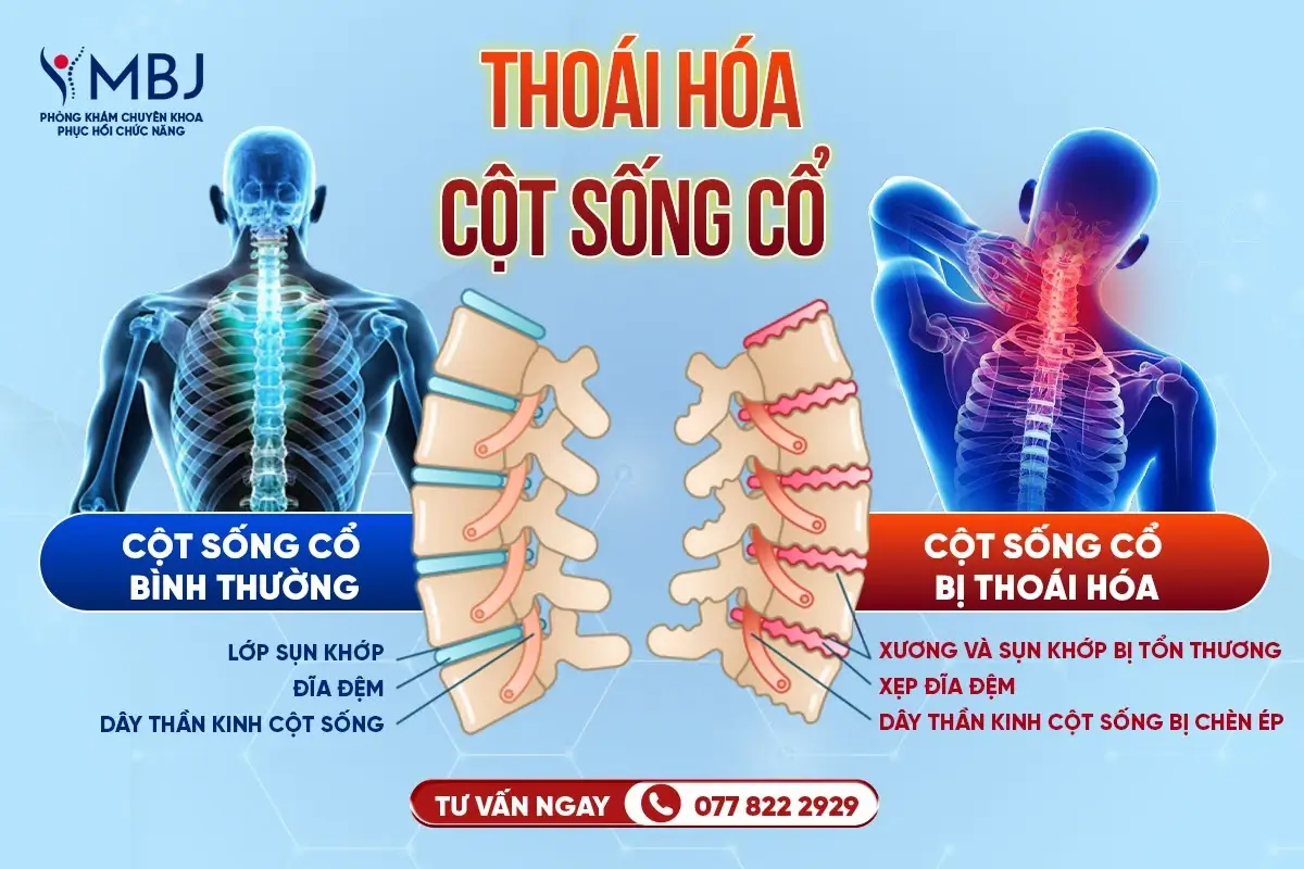 điều trị thoái hóa cột sống cổ