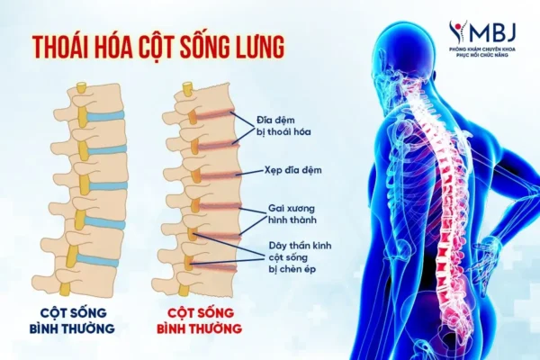 điều trị thoái hóa cột sống lưng
