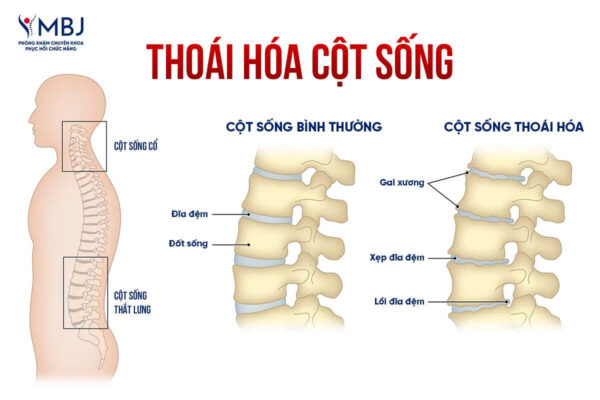 Phân biệt thoái hóa cột sống và thoát vị đĩa đệm