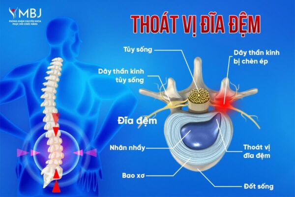 Phân biệt thoái hóa cột sống và thoát vị đĩa đệm