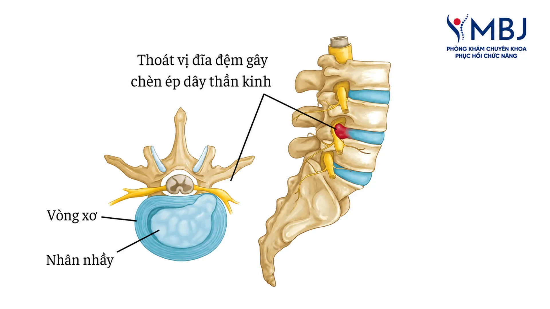 Sơ đồ thoát vị đĩa đệm: nhân nhầy thoát ra chèn ép rễ thần kinh