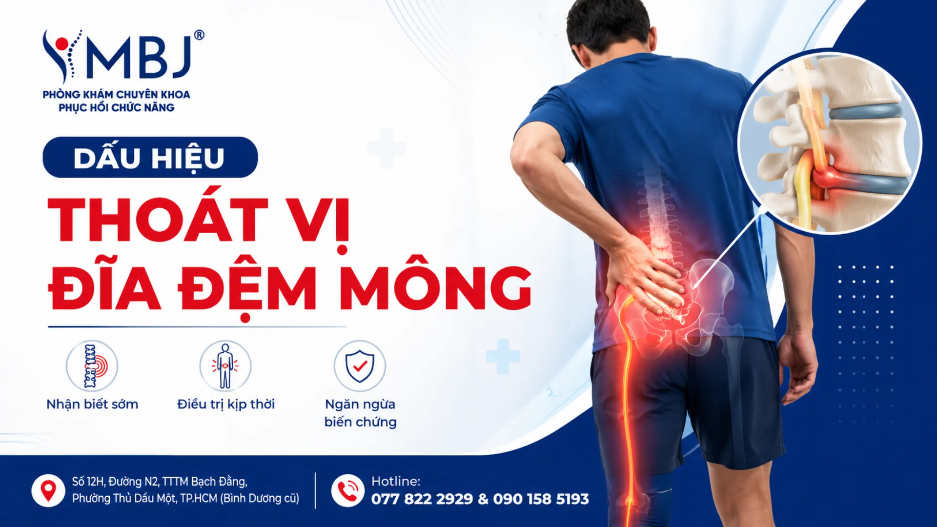 Dấu hiệu thoát vị đĩa đệm mông và cách nhận biết sớm