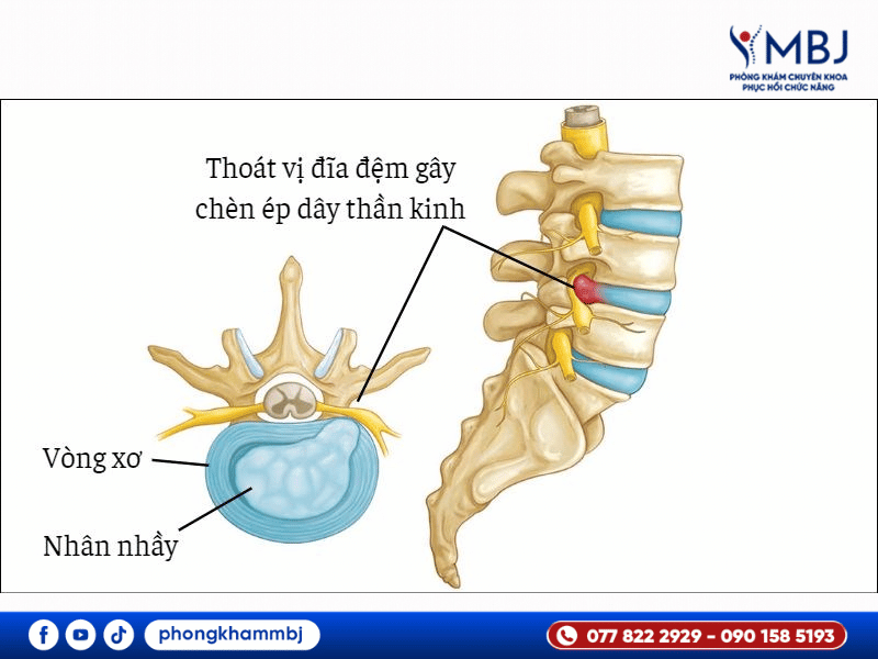 hình ảnh minh họa biểu hiện thoát vị đĩa đệm