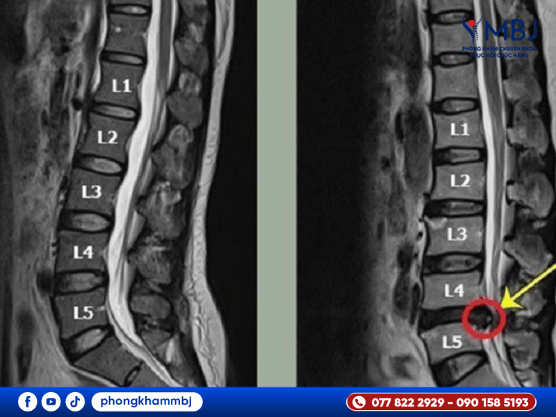 ảnh chụp X-Quang thoát vị đĩa đệm L4 L5