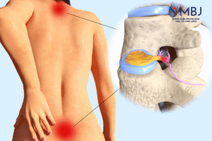 hình minh họa thoát vị đĩa đệm L4 L5