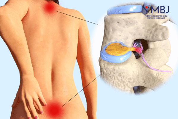 hình minh họa thoát vị đĩa đệm L4 L5