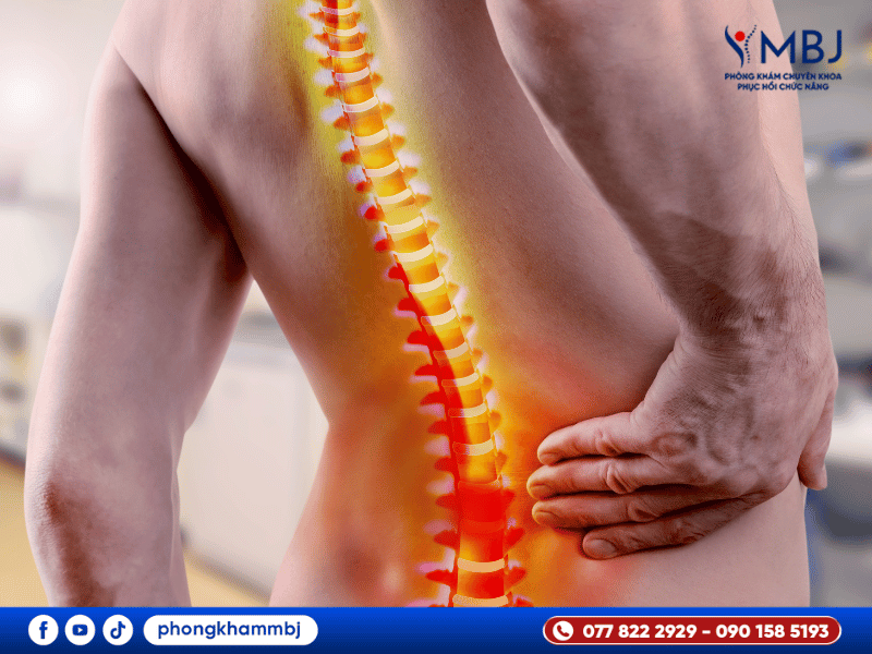 Nhận biết thoát vị đĩa đệm cột sống thắt lưng