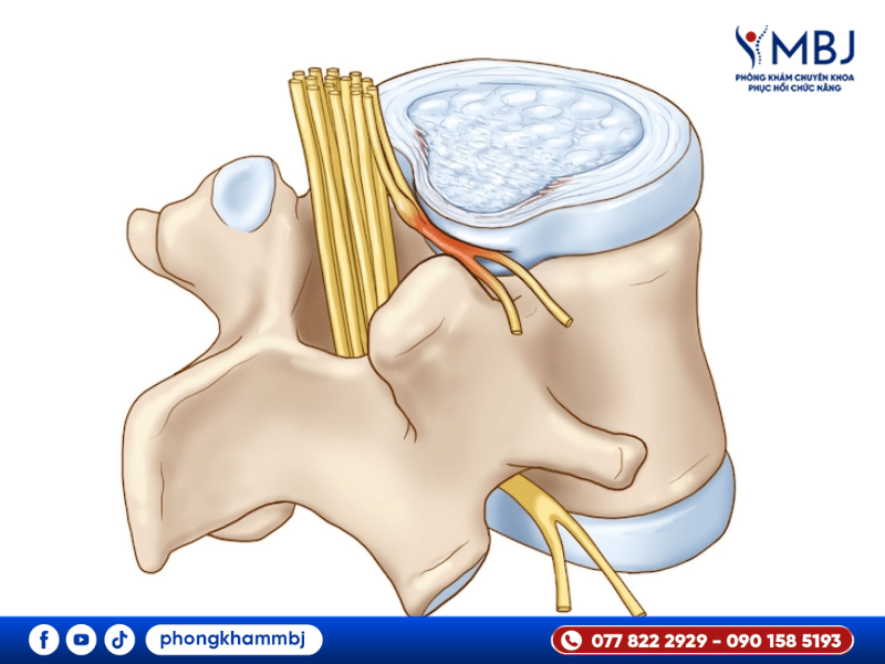 hội chứng rễ thần kinh