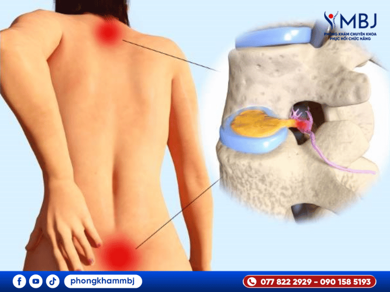 ảnh minh họa thoát vị đĩa đệm mông