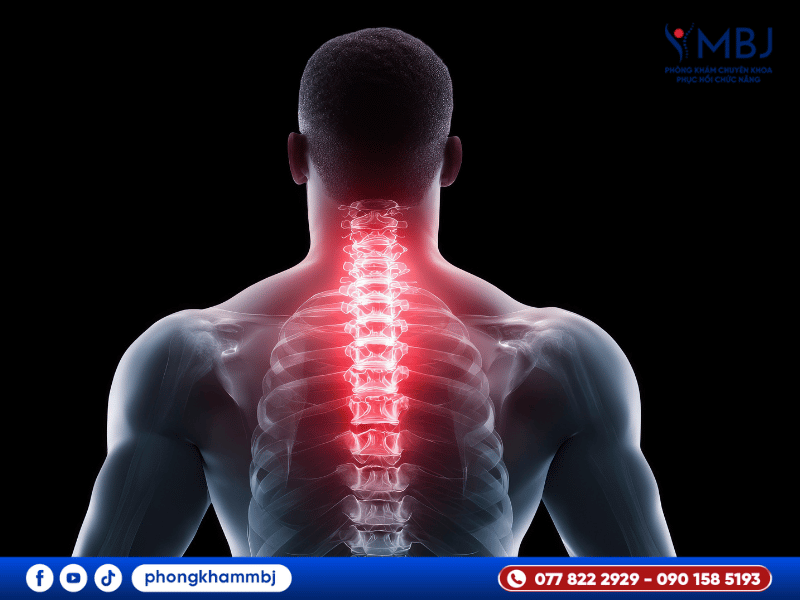 cách nhận biết dấu hiệu thoát vị đĩa đệm cổ