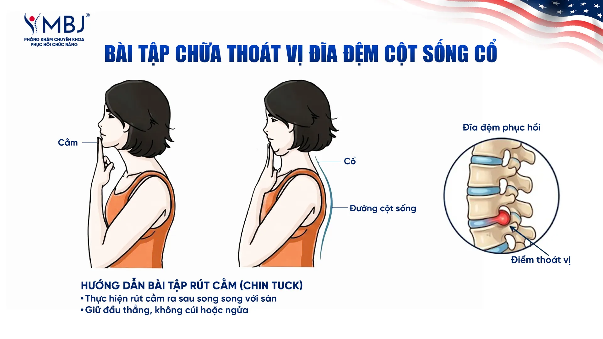 Bài tập chữa thoát vị đĩa đệm cột sống cổ