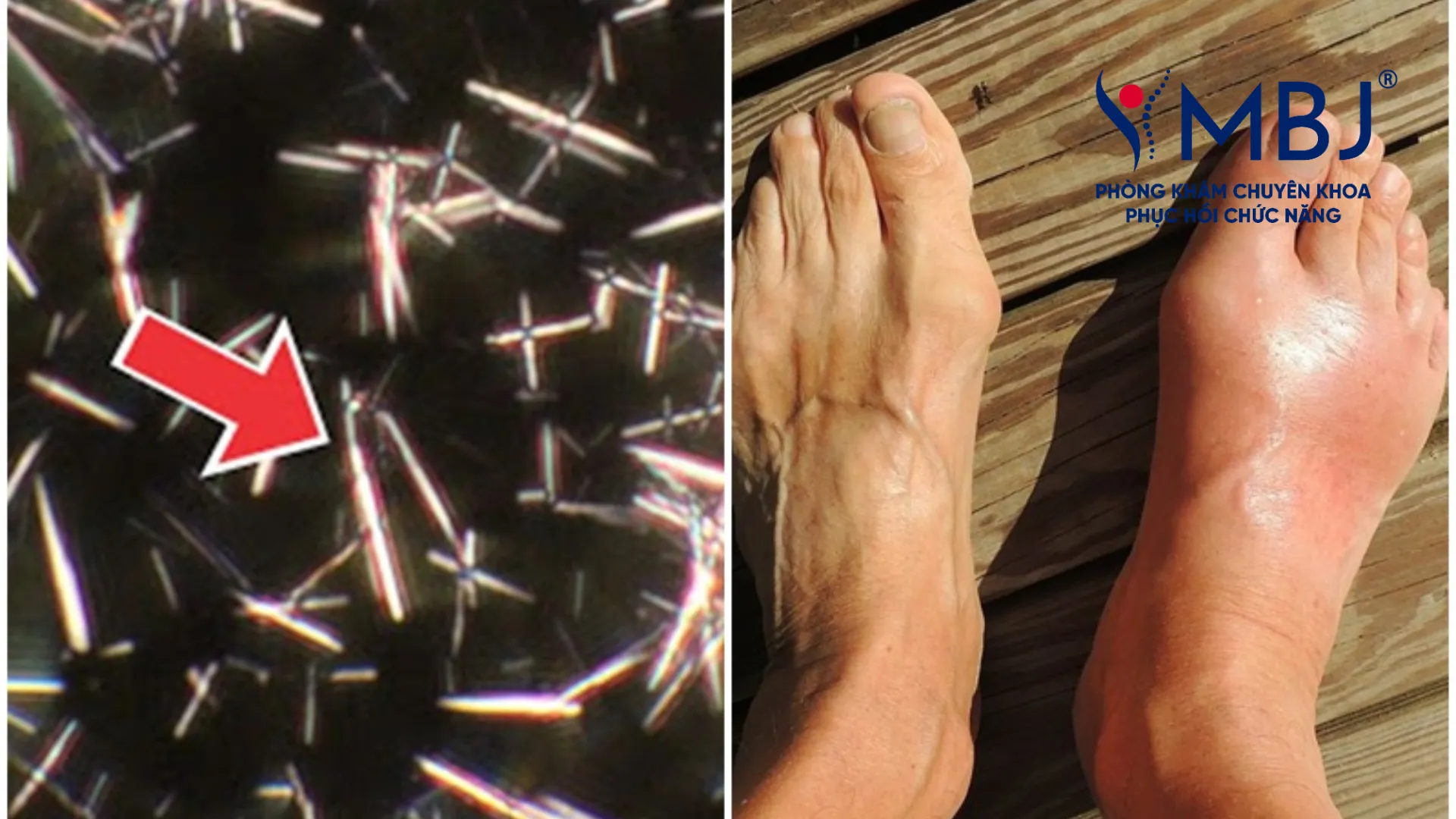 Bệnh gout viêm khớp do tinh thể urat