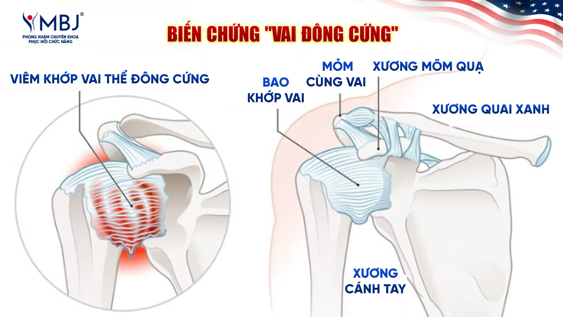 Biến chứng vai đông cứng