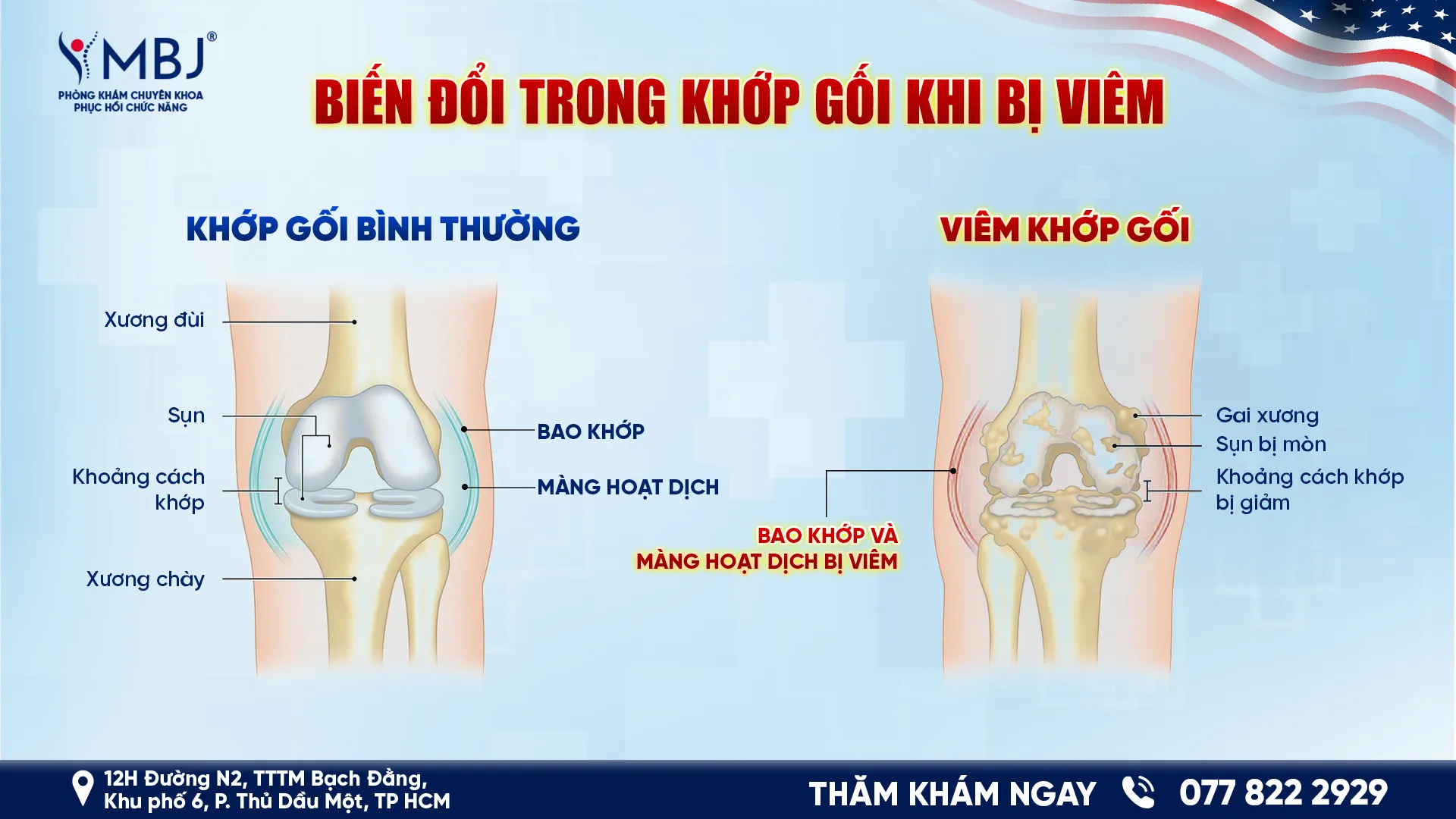 Biến đổi trong khớp gối khi bị viêm