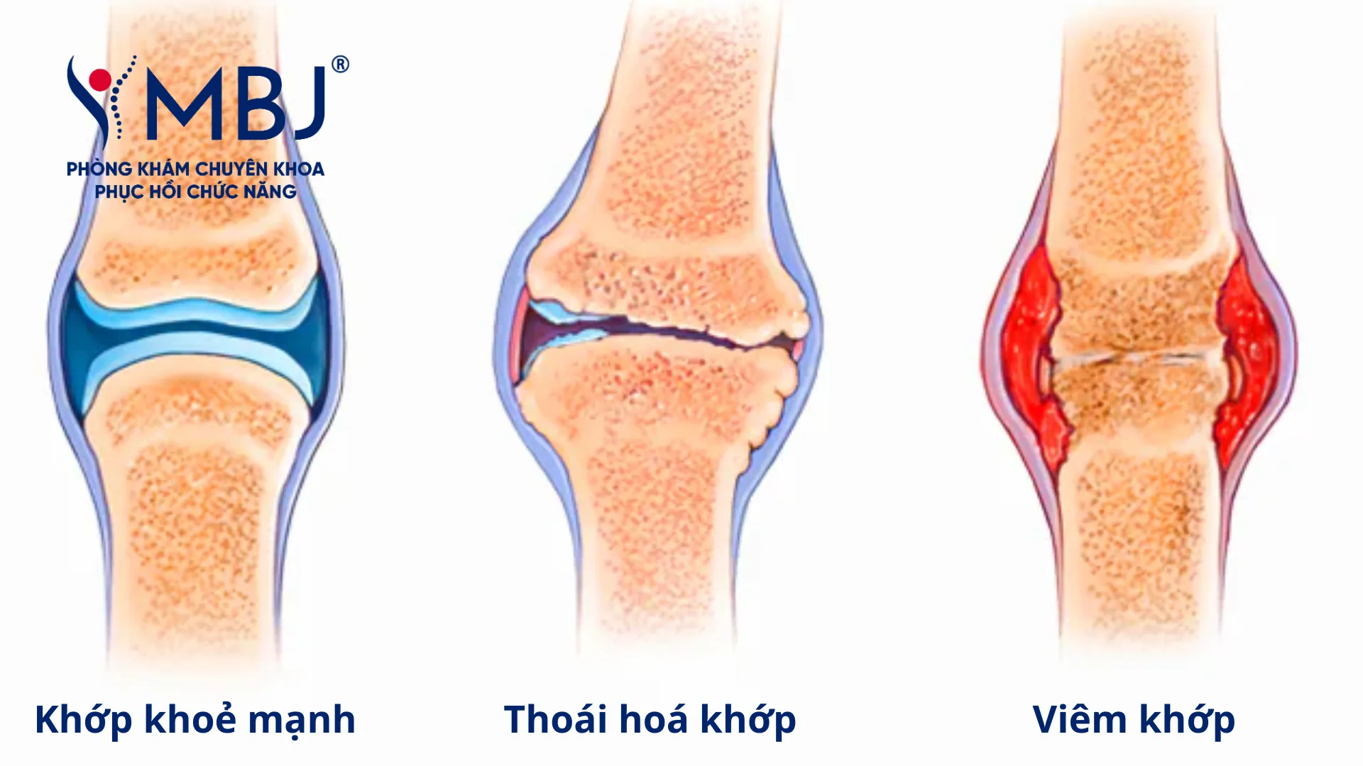 Các giai đoạn của viêm khớp