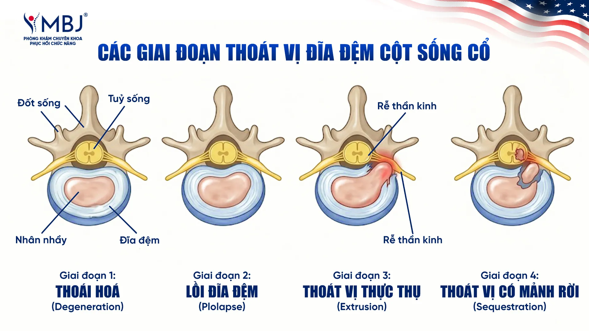 Các giai đoạn thoát vị đĩa đệm cột sống cổ