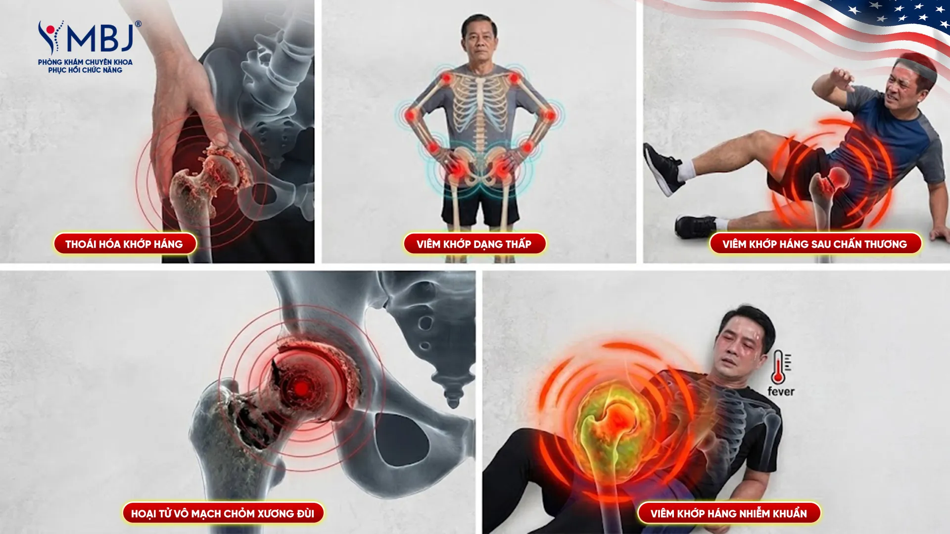 Các tình trạng viêm khớp háng thường gặp