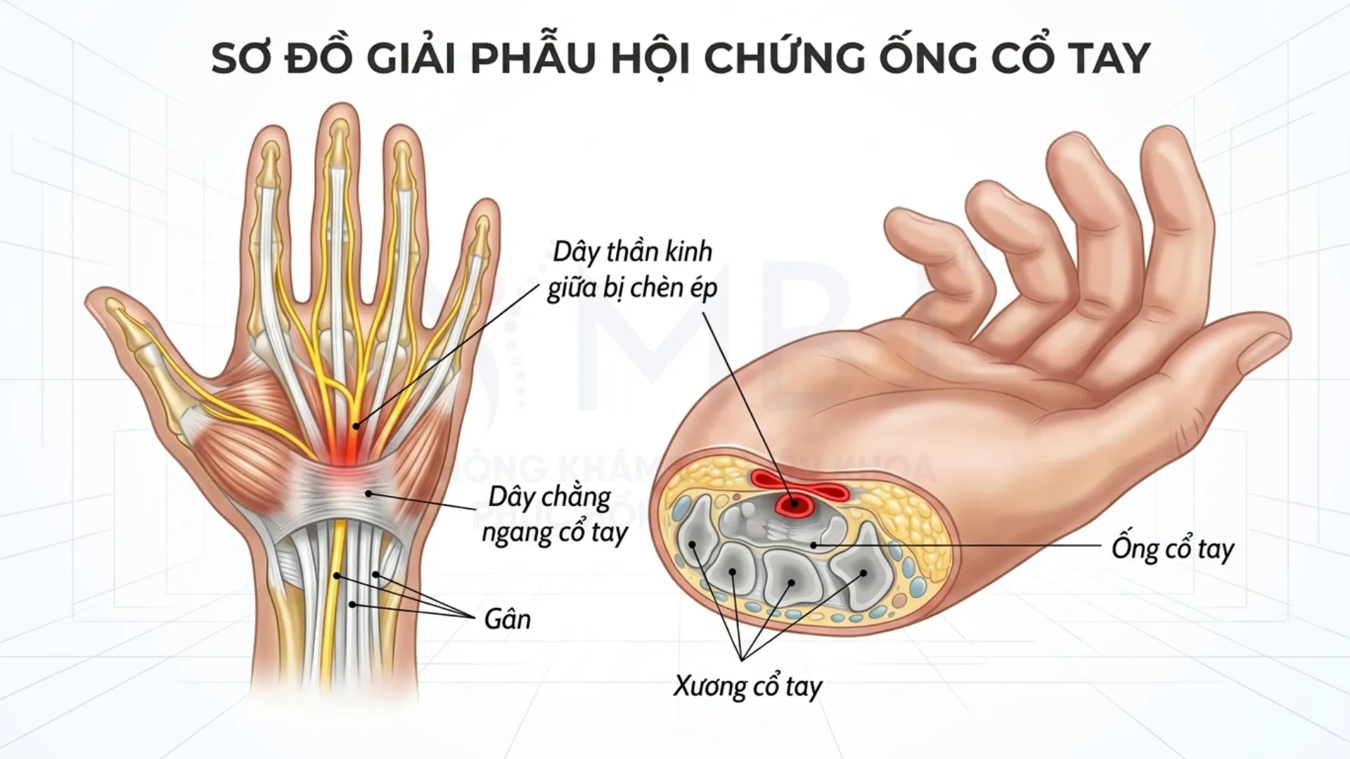 Hội chứng ống cổ tay có thể điều trị bằng laser cường độ cao
