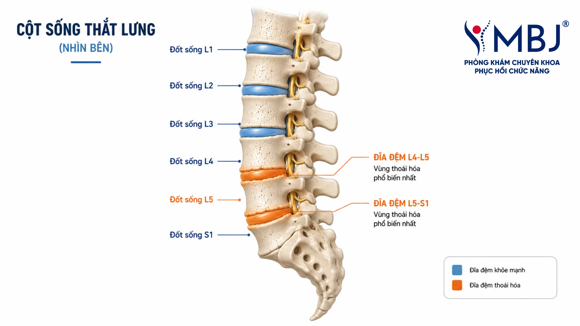 Sơ đồ giải phẫu cột sống thắt lưng từ L1 đến S1, vị trí thoái hóa phổ biến nhất tại đĩa đệm L4-L5 và L5-S1 được đánh dấu