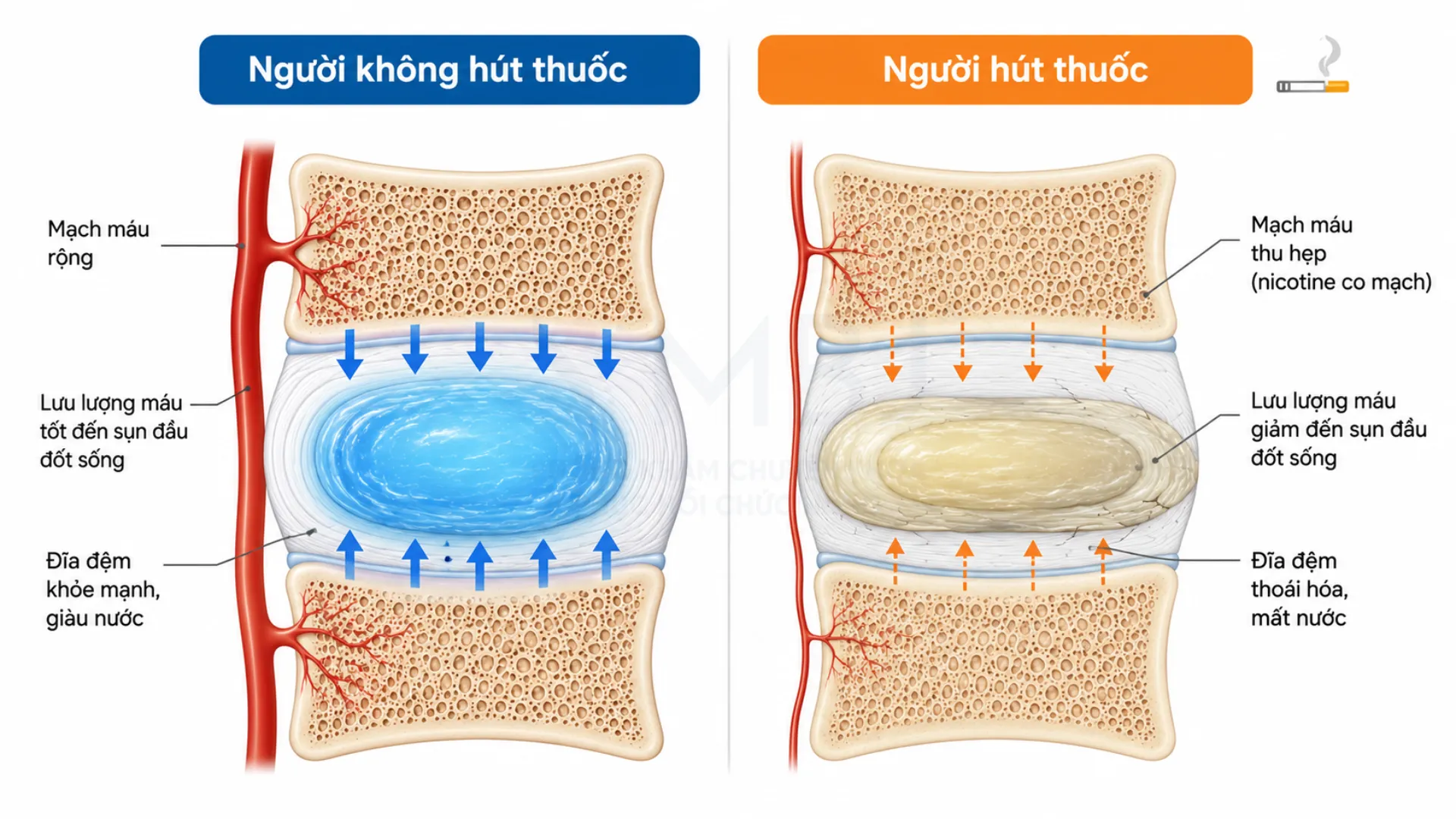 Hút thuốc lá làm giảm lưu lượng máu đến đĩa đệm, thúc đẩy thoái hóa cột sống