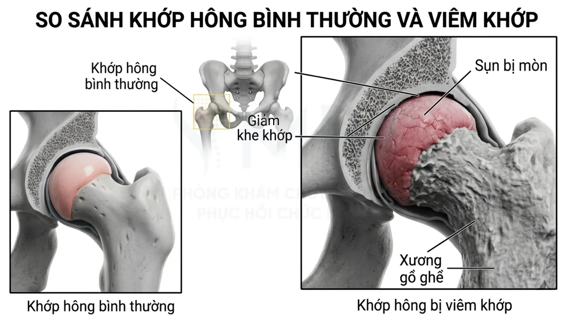 So sánh khớp bình thường vs khớp bị viêm